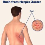 About Herpes Zoster – Complications,  Features