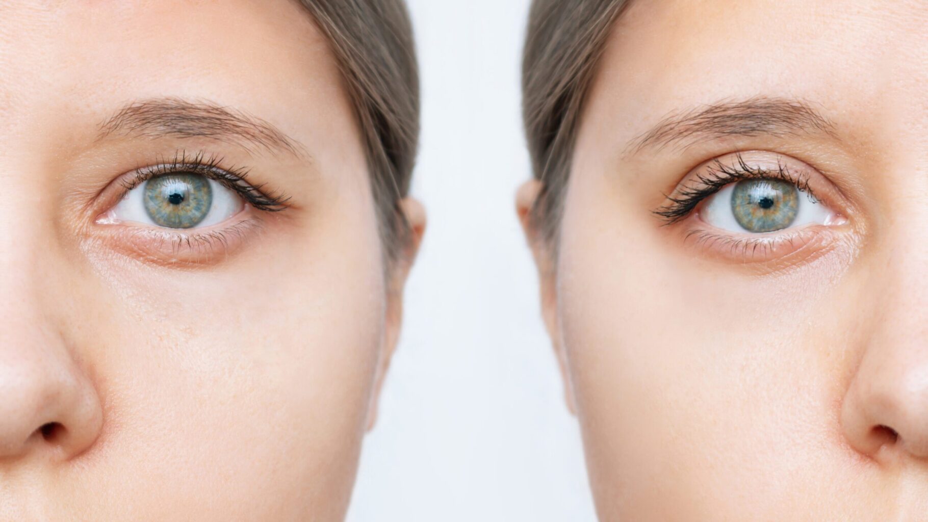 blepharoplasty