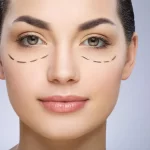 About Blepharoplasty