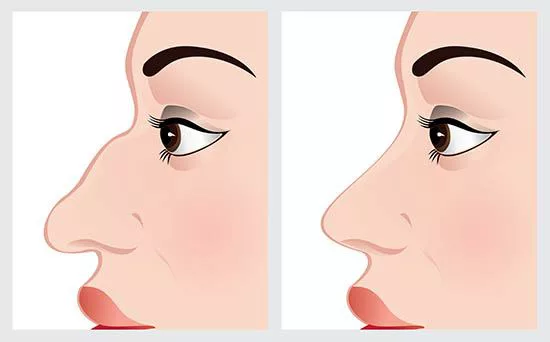 rhinoplasty surgery karnal