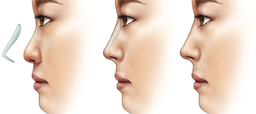 rhinoplasty surgery panipat